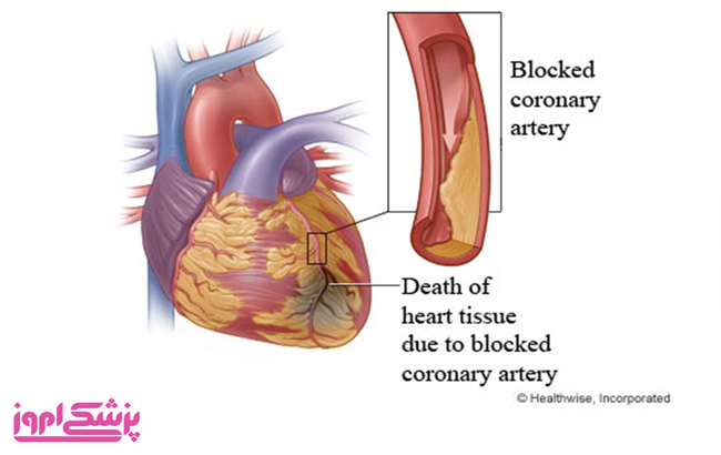 عوامل خطرزای سکته قلبیر|بیمار|بیماری|سکته|سکته قلبی|حمله قلبی|قلب